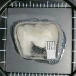нанопокрытие для полной защиты и восстановления зубной эмали